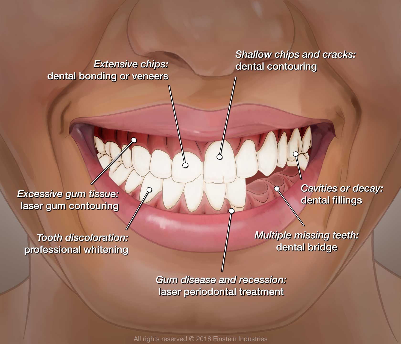 Diagram of how different cosmetic procedures target different parts of mouth