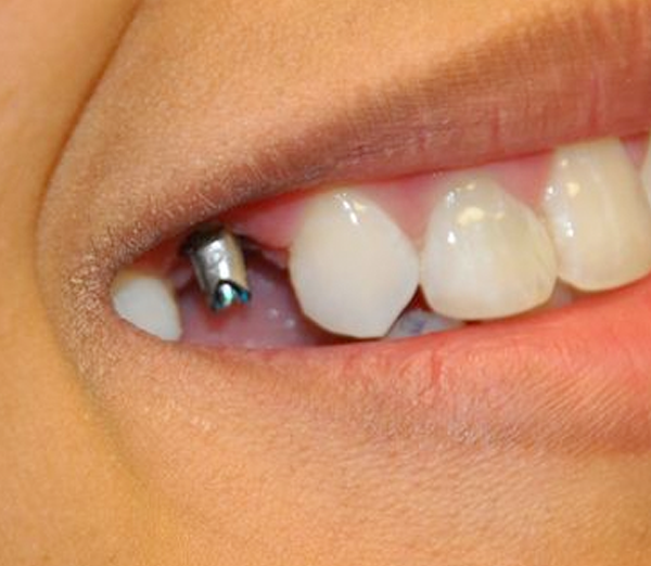 Before implant placement