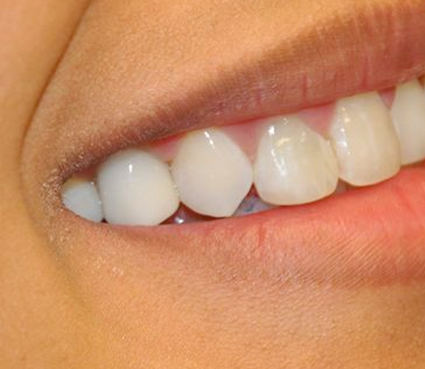 After implant placement