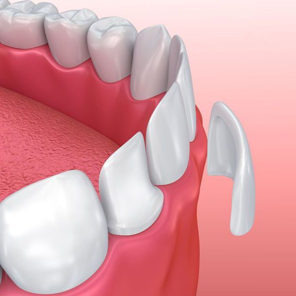 Porcelain Veneers