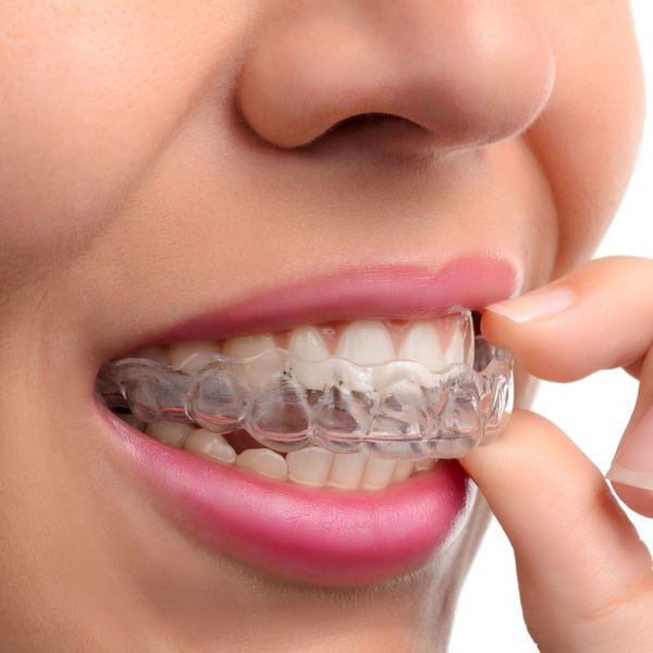 clear dental aligner
