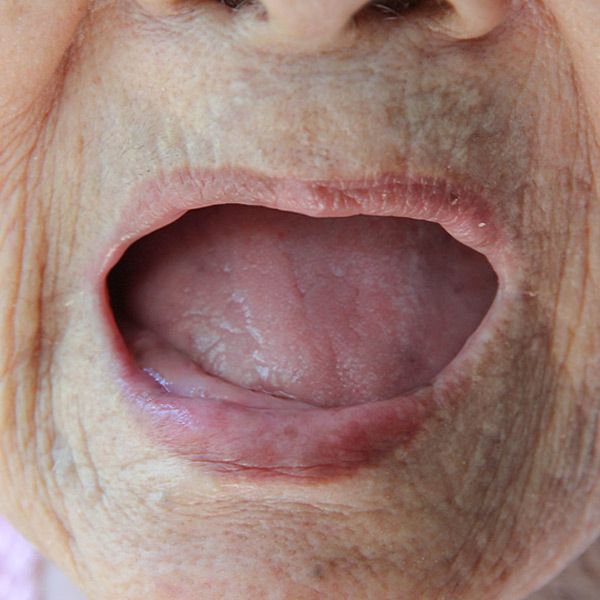 Patient missing all teeth