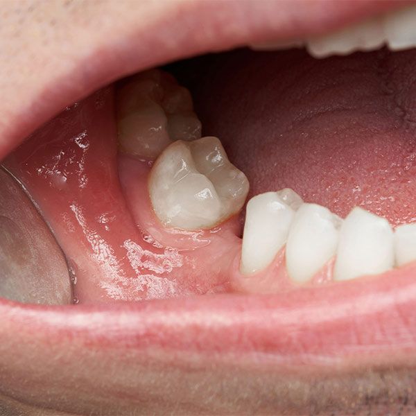 Patient missing single tooth